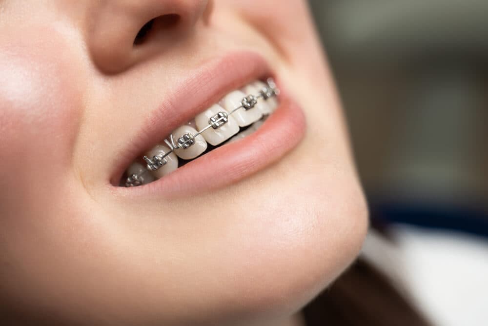 Orthodontie Invisalign pour un sourire aligné